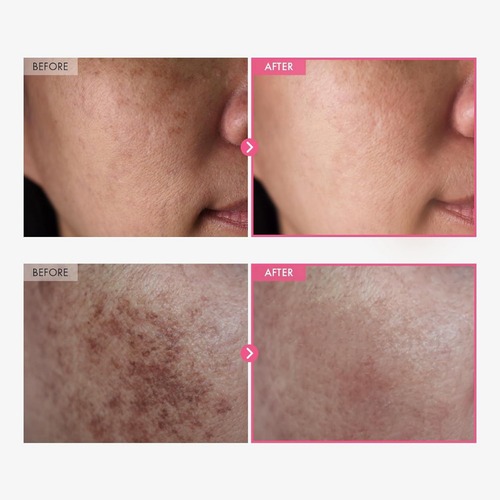 Arbutin 7% + Tranexamic Acid 4% Brightening Cream